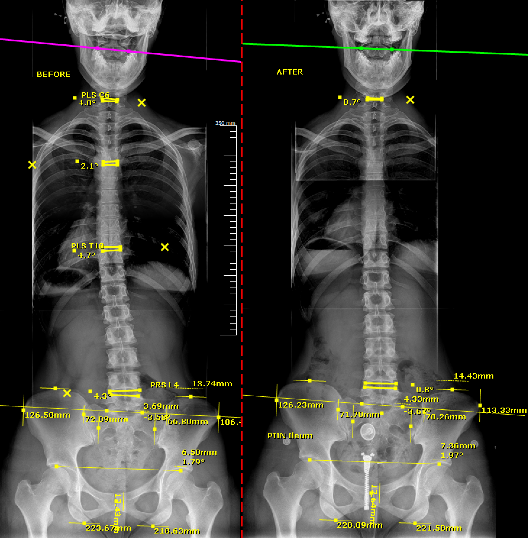 Before and after AP spinal X-ray comparison showing improved cervical, thoracic, and pelvic alignment measurements