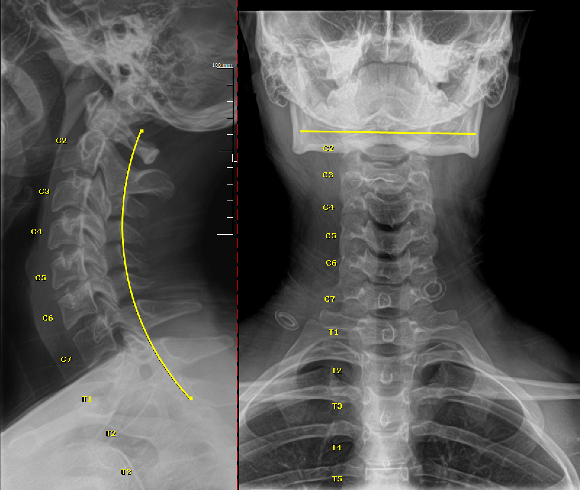 After chiropractic care: cervical X-ray showing improved cervical curve and alignment