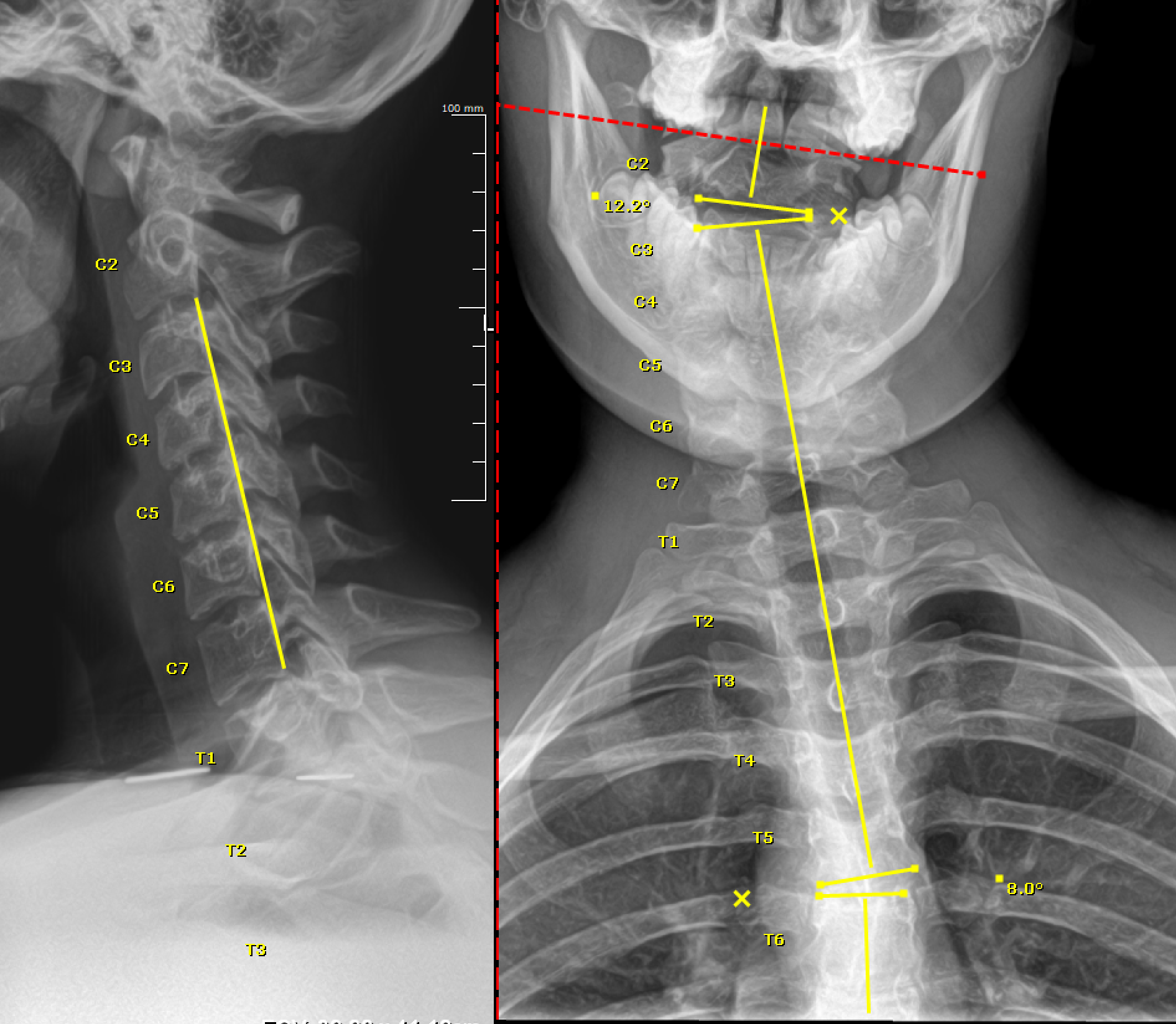 Before chiropractic care: cervical X-ray showing torticollis with significant curve and rotation of the neck